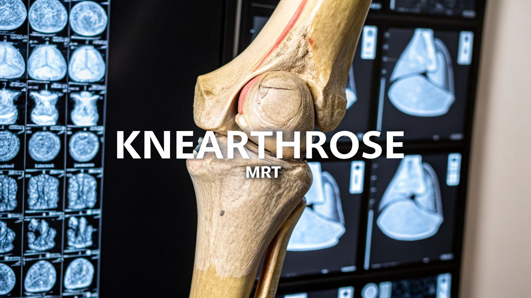 arthrose knie mrt: Bilder richtig deuten
