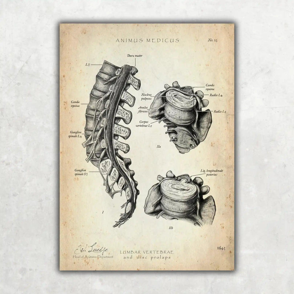 Bandscheibenvorfall Anatomie Poster - Animus Medicus GmbH