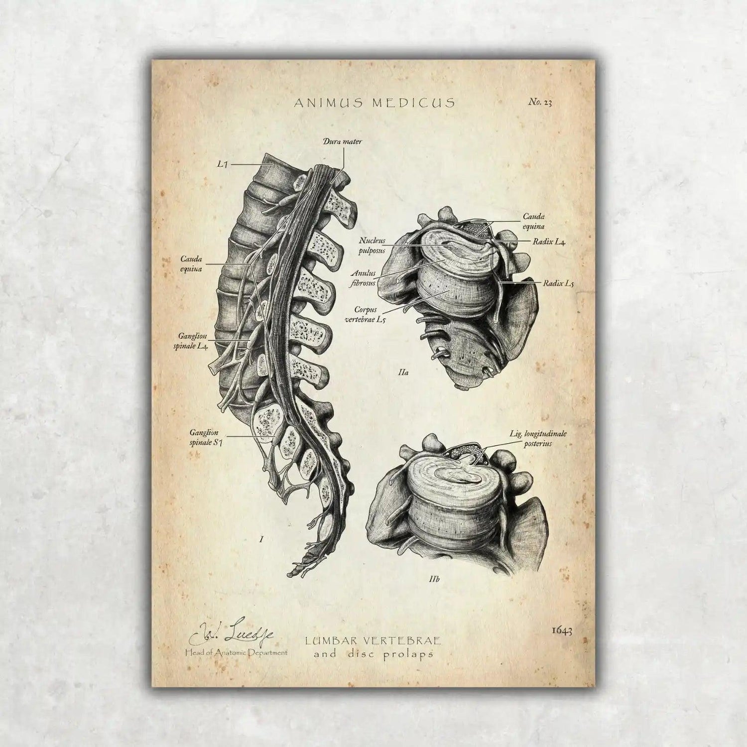 Bandscheibenvorfall Anatomie Poster - Animus Medicus GmbH