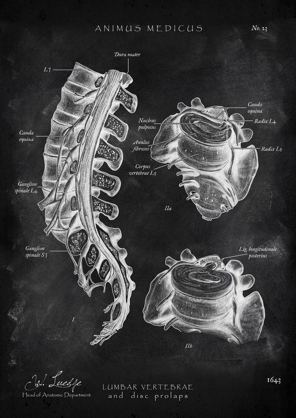 Bandscheibenvorfall Anatomie - Chalkboard