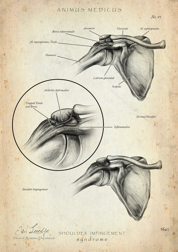 Schulter Impingement