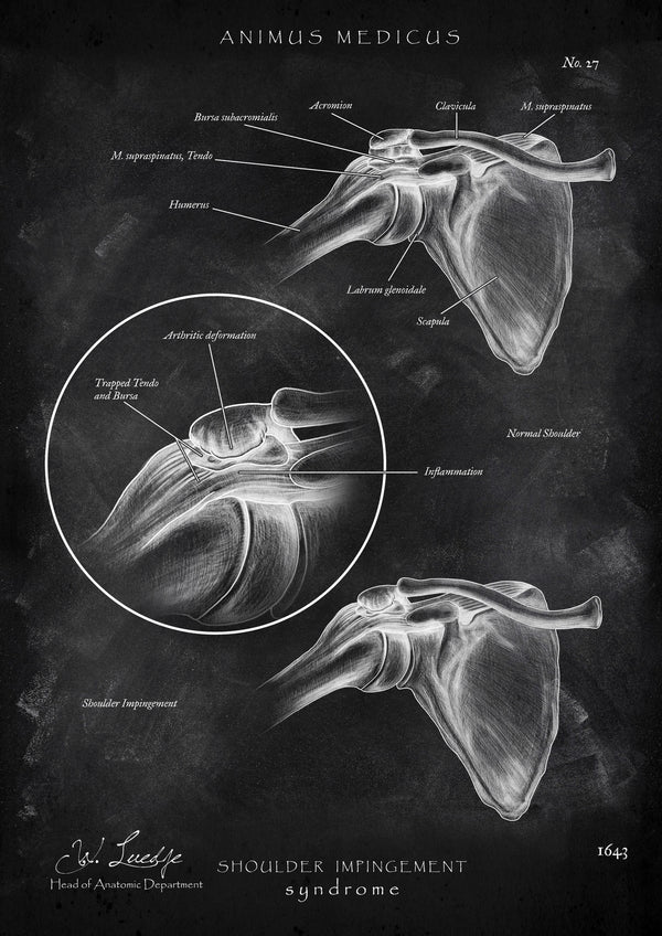 Schulter Impingement - Chalkboard