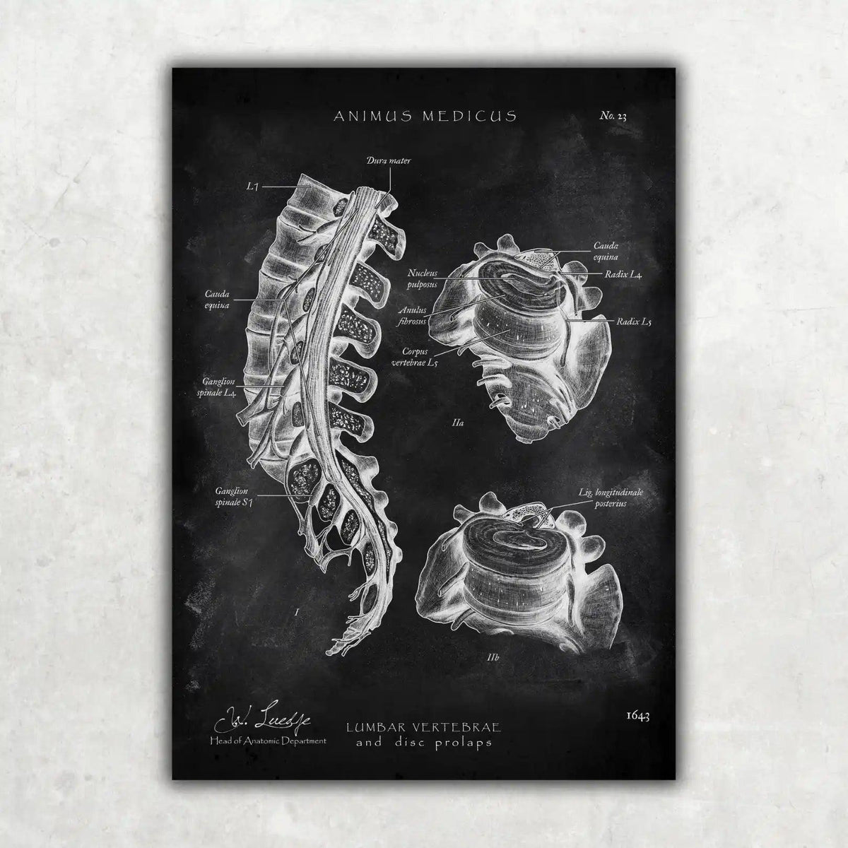 Bandscheibenvorfall Anatomie - Chalkboard - Animus Medicus GmbH