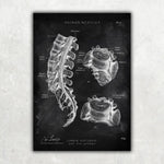 Bandscheibenvorfall Anatomie - Chalkboard - Animus Medicus GmbH