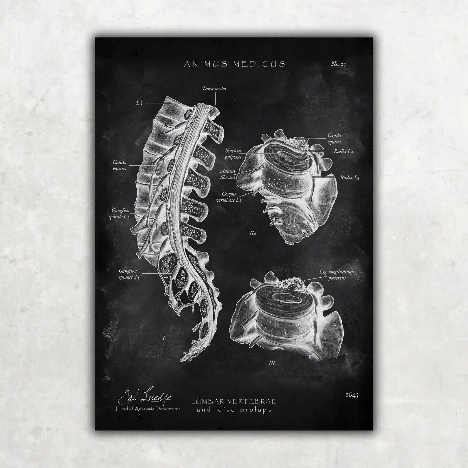 Bandscheibenvorfall Anatomie - Chalkboard - Animus Medicus GmbH