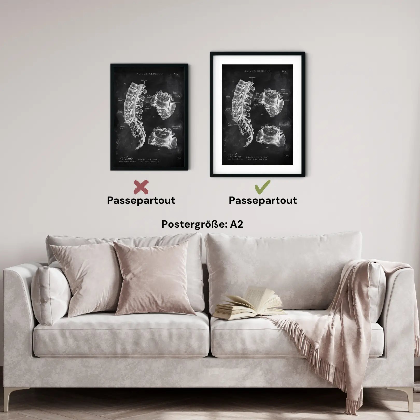 Bandscheibenvorfall Anatomie - Chalkboard - Animus Medicus GmbH